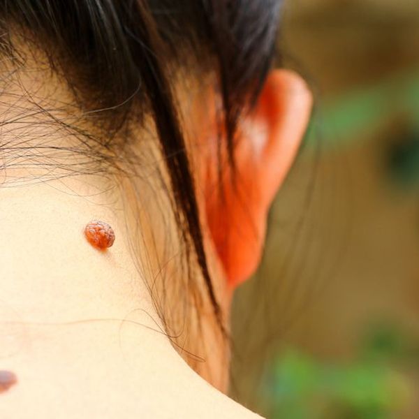 Woman with mole