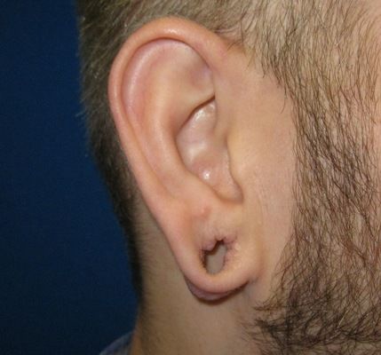 Before gauge earlobe repair gauge earlobe repair connecticut jandali plastic surgery