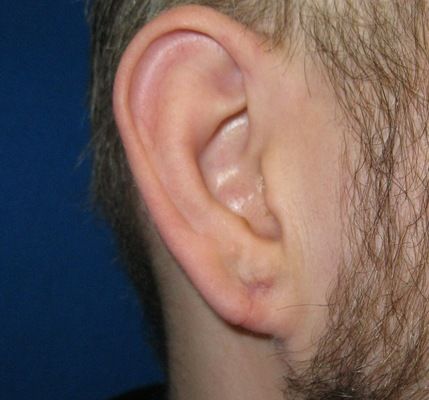 After gauge earlobe repair gauge earlobe repair connecticut jandali plastic surgery