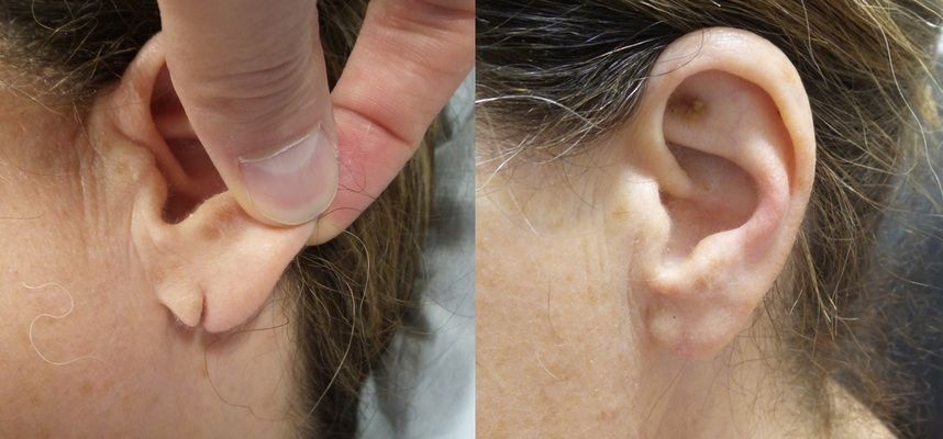 Split Torn Stretched Earlobe Repair Connecticut