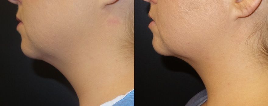 Kybella Connecticut