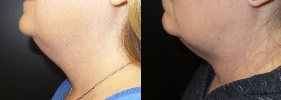 Kybella Connecticut