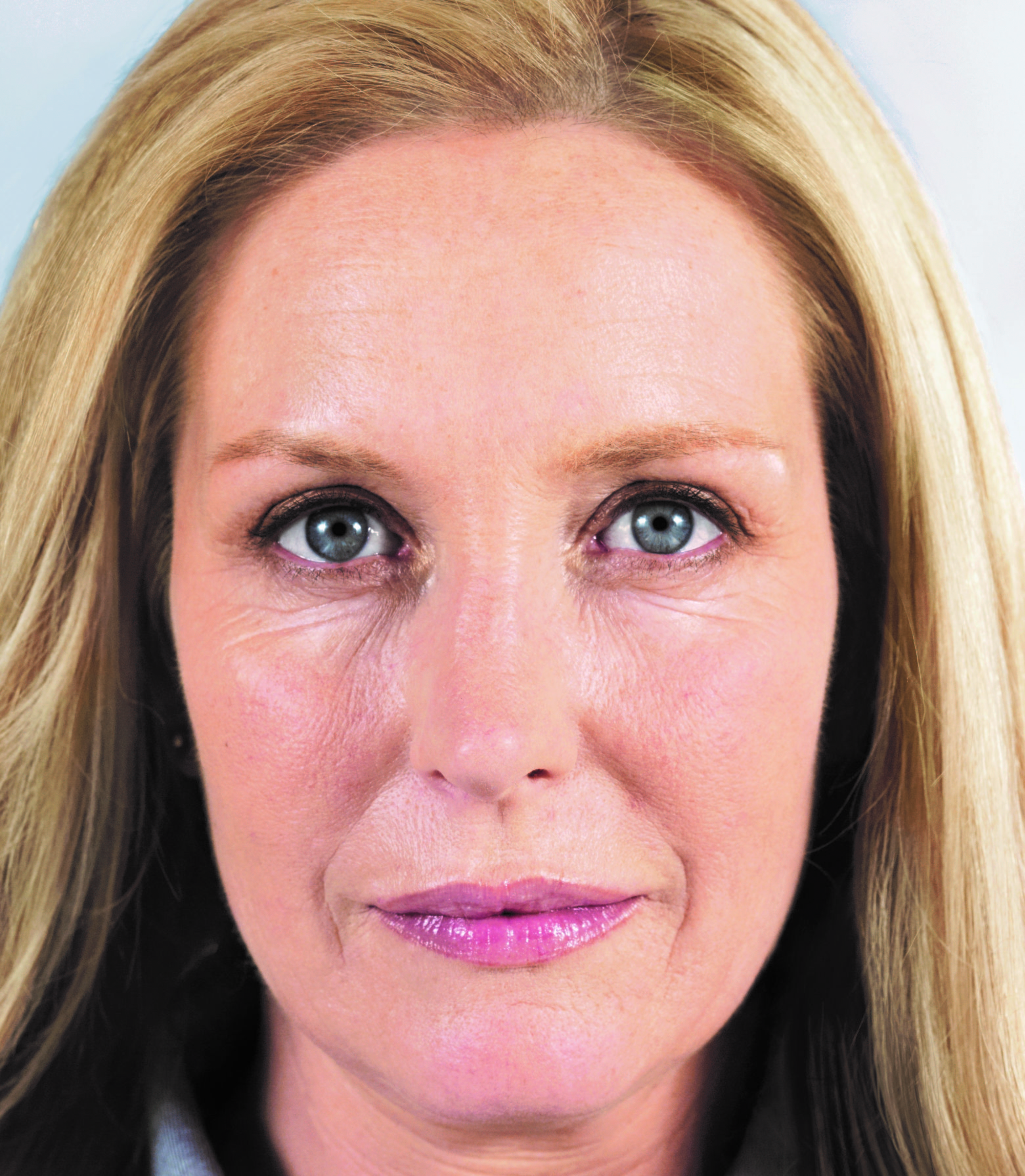 Sculptra before and after photo