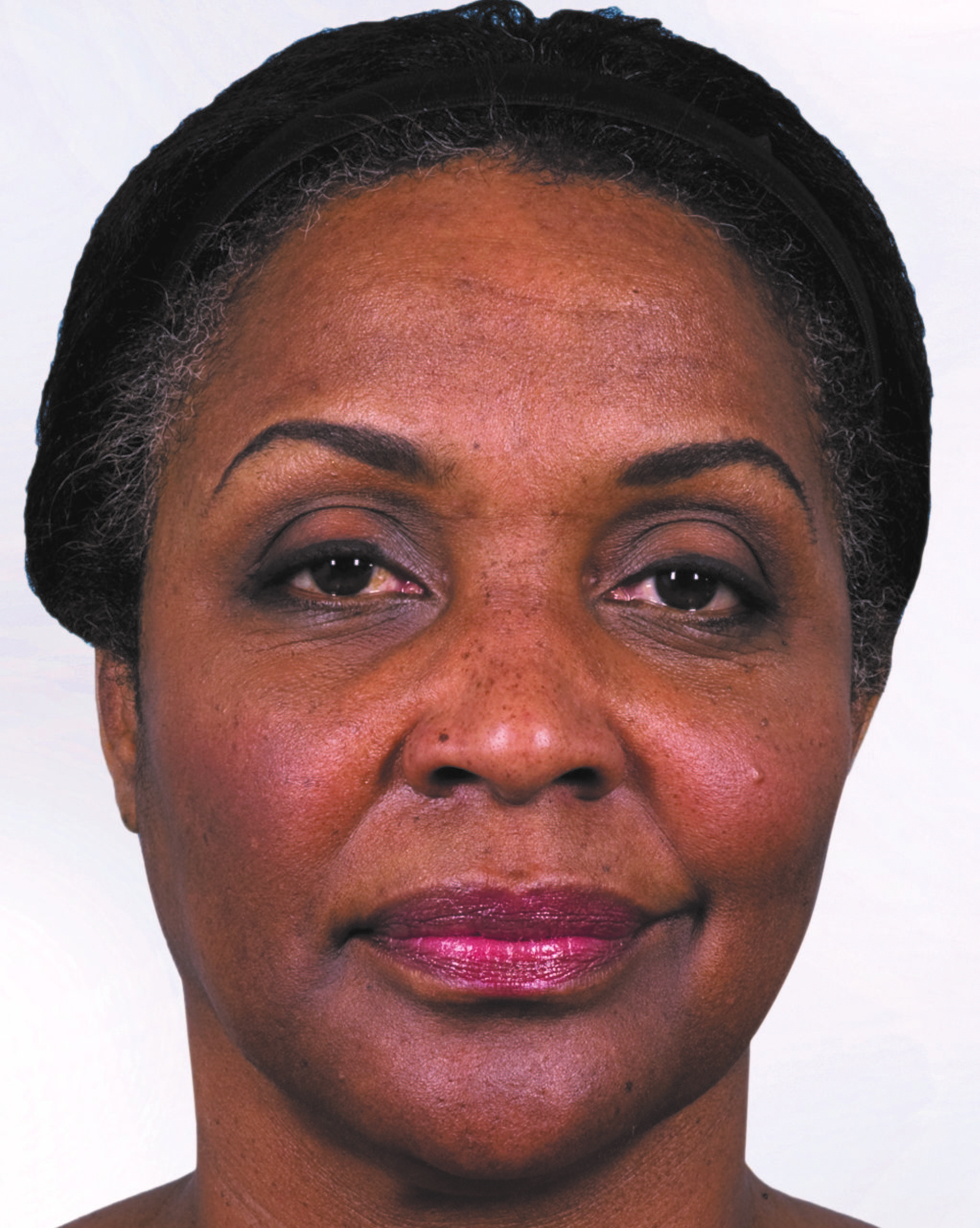 Sculptra before and after photo