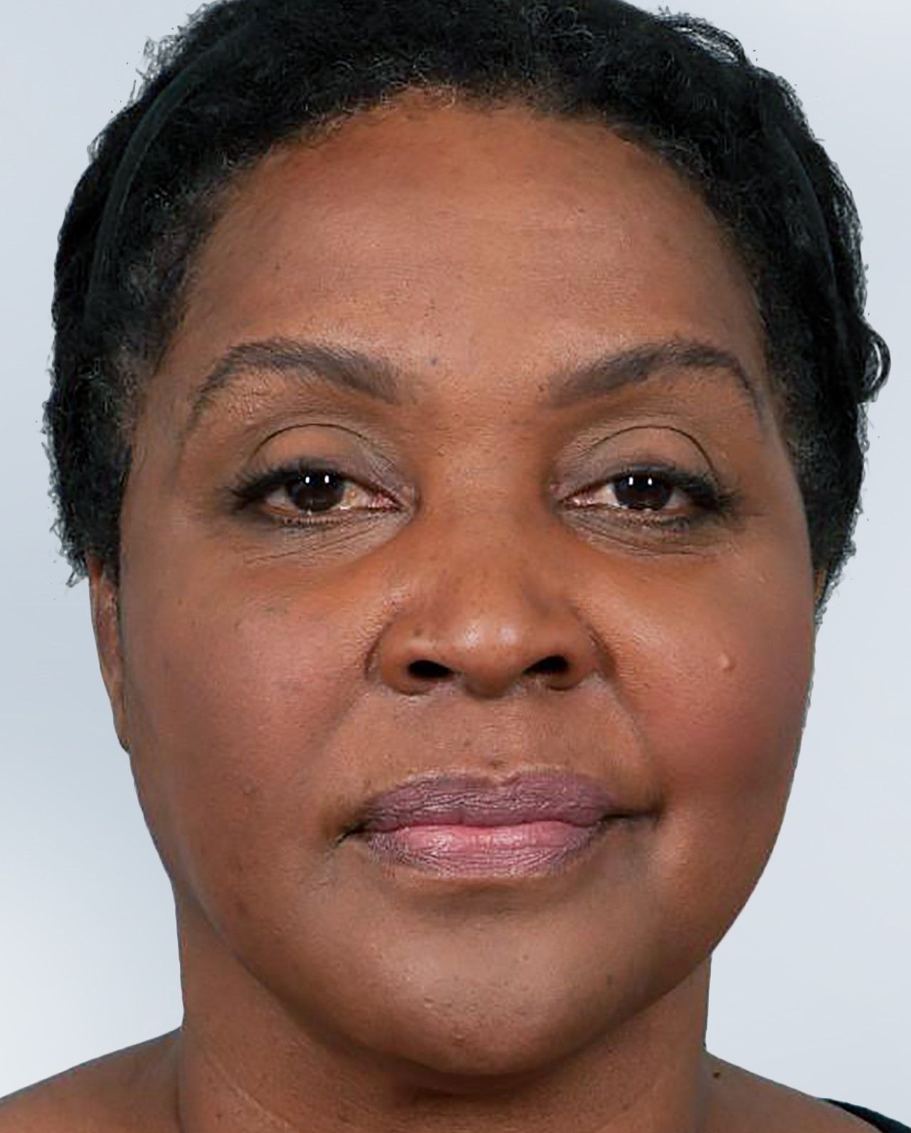 Sculptra before and after photo