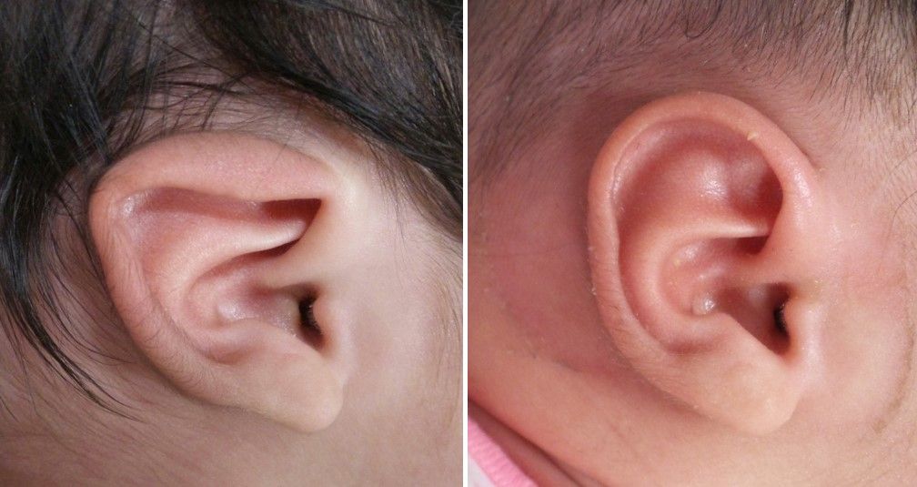 ear lidding deformity