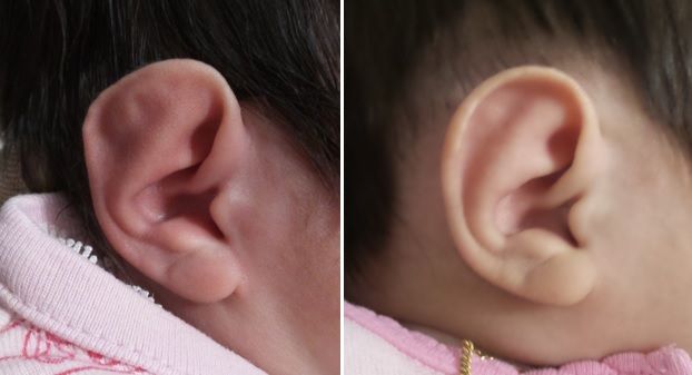 flat baby ear