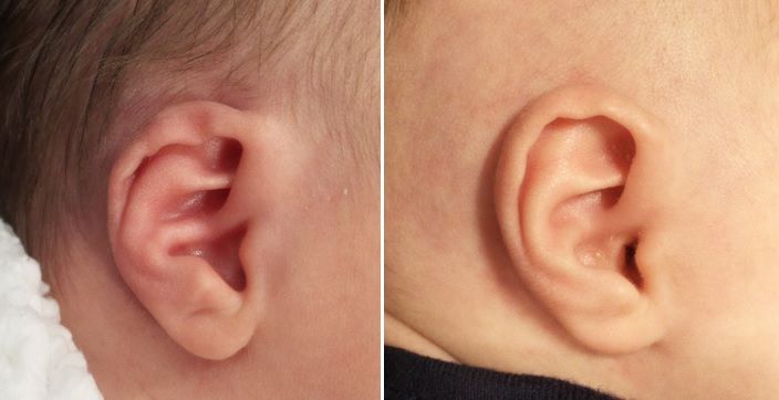 crooked baby ear cartilage