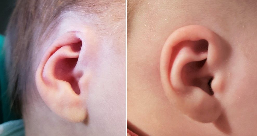 cryptotia ear deformity correction