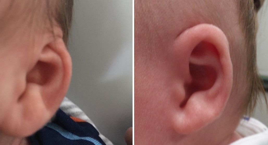 top of ear hidden under skin