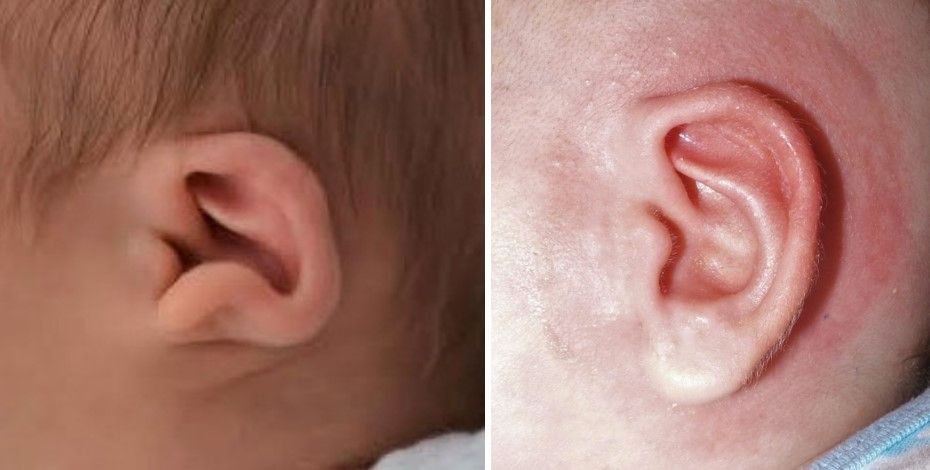 constricted ear deformity