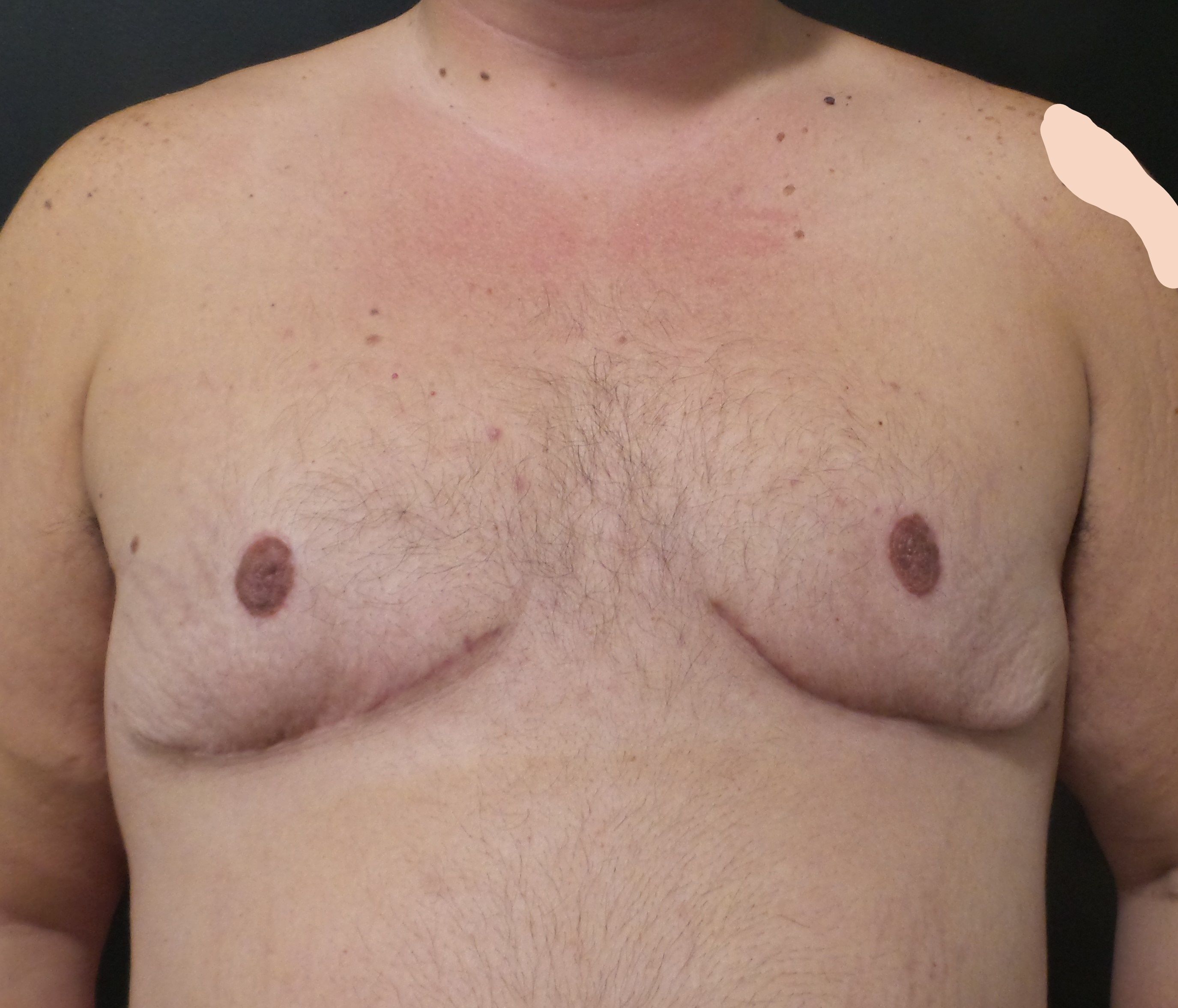 After top surgery