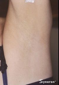 Laser Hair Removal Laser Hair Removal Underarms - Jandali Plastic Surgery - Connecticut