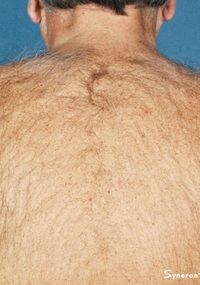 Laser Hair Removal Laser Back Hair Removal - Jandali Plastic Surgery - Connecticut