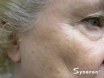 IPL brown sun spot laser removal - Jandali Plastic Surgery - Connecticut