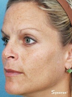 IPL hyperpigmentation laser removal - Jandali Plastic Surgery - Connecticut