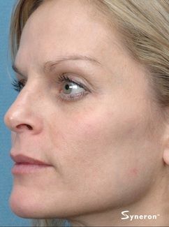 IPL hyperpigmentation laser removal - Jandali Plastic Surgery - Connecticut