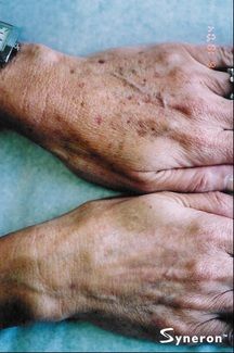 IPL hand rejuventation for brown spots - Jandali Plastic Surgery - Connecticut