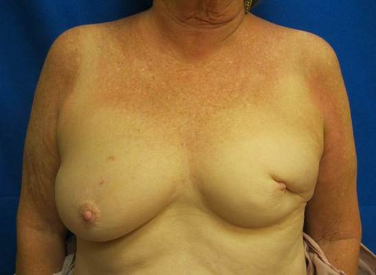 without oncoplastic breast surgery jandali plastic surgery connecticut