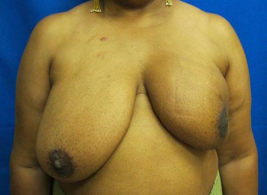 without oncoplastic breast surgery jandali plastic surgery connecticut