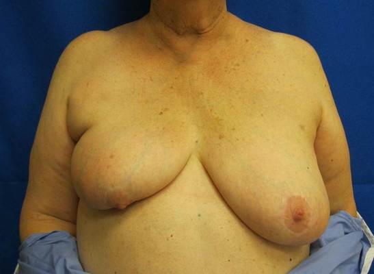 without oncoplastic breast surgery jandali plastic surgery connecticut