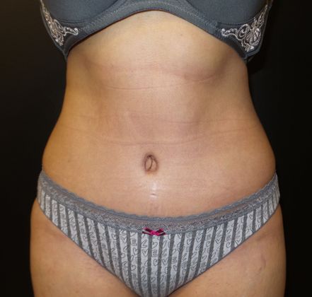 After body contouring